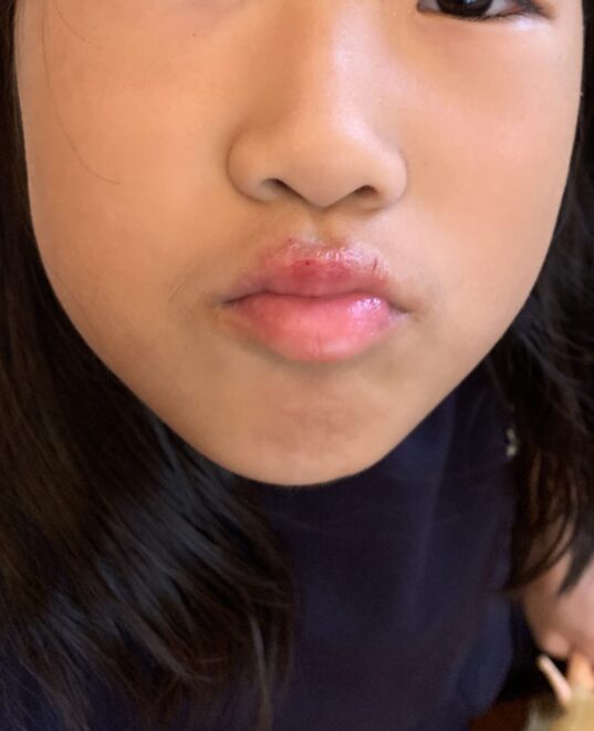 唇が腫れ上がった、看板娘ひなまるちゃん